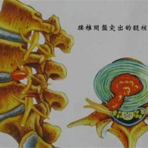 哪些习惯可以有效预防腰间盘突出？